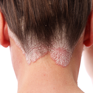 Psoriasis