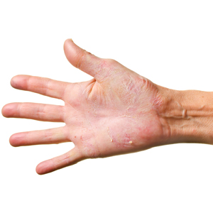 Eczema