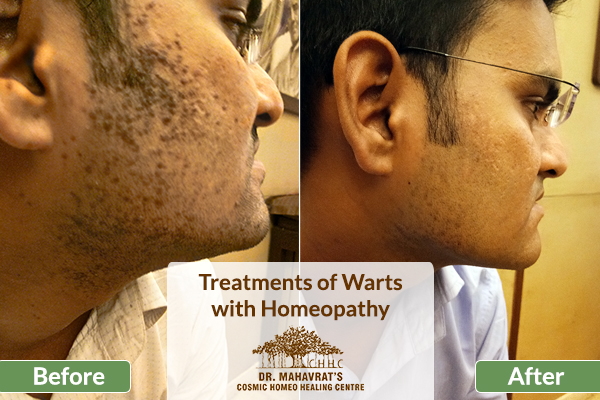 Treatments of Warts