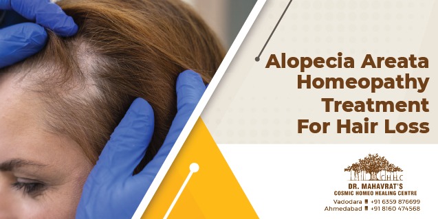 alopecia-areata