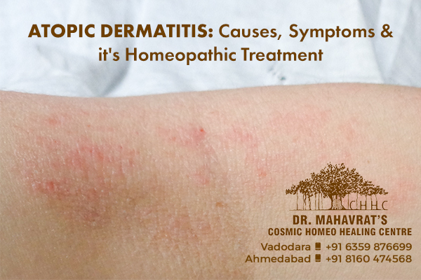 Atopic Dermatitis