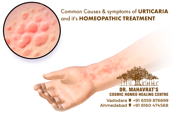 Common Causes & symptoms of Urticaria and it's Homeopathic Treatment