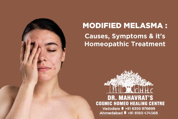 Modified Melasma: Causes, Symptoms & it’s Homeopathic Treatment