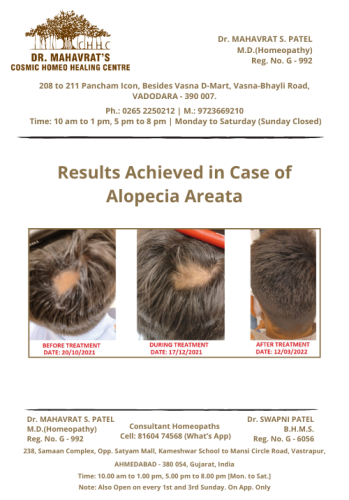Alopecia Areata
