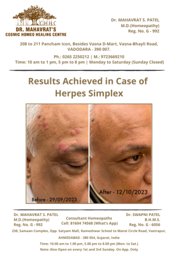 Herpes Simplex
