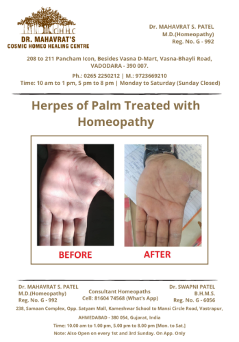 Herpes of palm