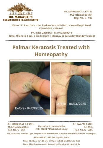 Palmar Keratosis
