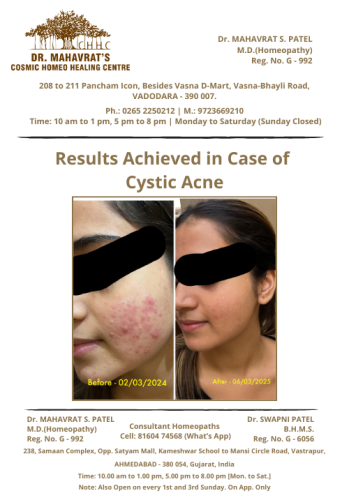 cystic acne